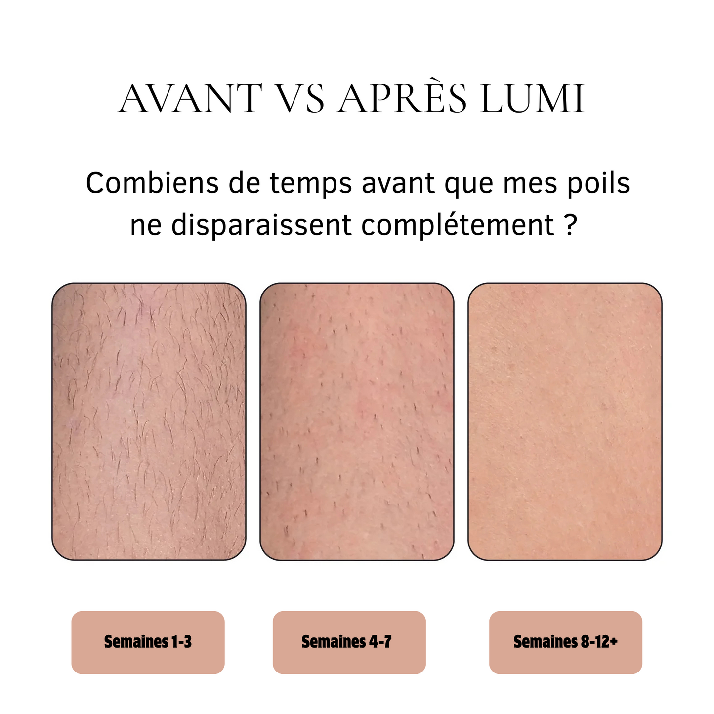 Dispositif d'épilation permanente